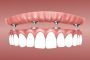 Zubni implantati – moderno rješenje za lijepi osmijeh